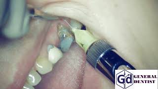 Infiltration anesthesia for extraction 26 tooth and implantation area 2526 [upl. by Ahsiekel788]