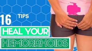 16 Best Natural Treatments For Hemorrhoids  How to Get Rid of Hemorrhoids at Home  WebMD [upl. by Datha]