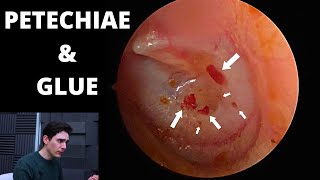 Petechiae And Glue Ear Urgent ENT Referral [upl. by Ahsieyt605]