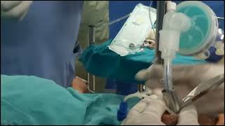 Endotracheal intubation with intubating LMA [upl. by Asaph56]