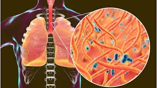 Pertussis Whooping Cough [upl. by Patt]