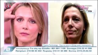 Dr Prinou Plasma • Lift χωρίς χειρουργείο ➜ Call us on2108010000 [upl. by Bergh]