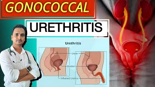 Gonococcal Urethritis treatment in Hindi  Homeopathic medicine for UTI  Neisseria Gonorrhoeae STD [upl. by Routh]