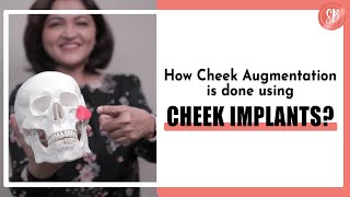 How is done Cheek Augmentation using Cheek Implants  Cheekbone Surgry  Cheek Bone Adjustment [upl. by Ynej]