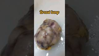 Breast lump excision biopsy for histopathology😨 breastcancer breastdisease breastfeeding lump [upl. by Chavey]