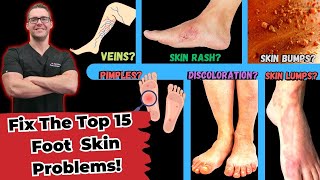 Top 15 Foot Skin Problems Toenail Fungus Dry Skin amp More [upl. by Nirel]