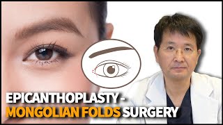 Epicanthoplasty  Eye Surgery that modifies the Epicanthal Folds [upl. by Alicsirp320]