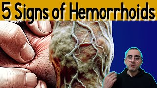 5 Signs of Hemorrhoids Causes and Treatment [upl. by Regor]