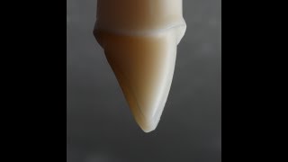 All Ceramic Crown Preparation for Emax and Zirconia [upl. by Debera124]