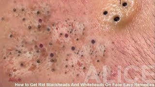 How to Get Rid Blackheads And Whiteheads On Face Easy Remedies [upl. by Leunad]