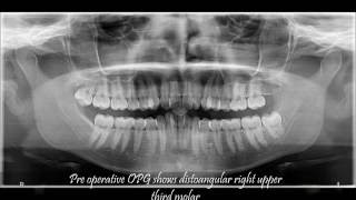 Conical rooted upper third molarluxation by coupland elevator [upl. by Froh]