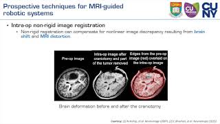 MRI Guided RobotAssisted Stereotactic Neurosurgery [upl. by Rayle]