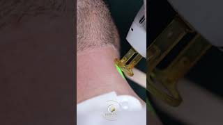 Laser Beard Shaping Dubai  beardshaping laserhairremoval candelagentlemaxpro [upl. by Rimidalb]