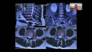 Difference between Modic changes amp Hemangioma in vertebral body Update on How to read MRI of spine [upl. by Flip]