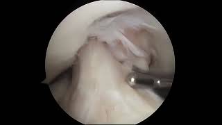 Torn Meniscus Arthroscopic Surgery [upl. by Joachim260]