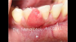 Excision of Gingival Epulis [upl. by Ultann]