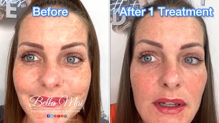 Derma 2 Bio Full Face Skin Rejuvenation  Before During After amp 2 Week Healing Process [upl. by Lovato]