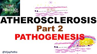 ATHEROSCLEROSIS  Part 2 Pathogenesis [upl. by Eceerehs]