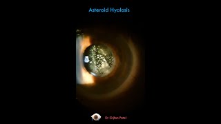 Asteroid Hyalosis [upl. by Charron393]