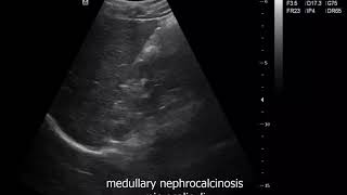 Case 516 ultrasound medullary nephrocalcinosis [upl. by Berns]