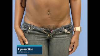 Liposuction with lower tummy skin removal [upl. by Sualk]