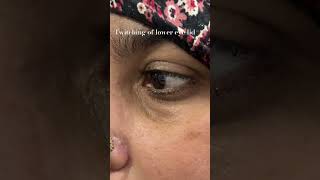 Twitching of lower eye lideyelid myokymia [upl. by Anileba]