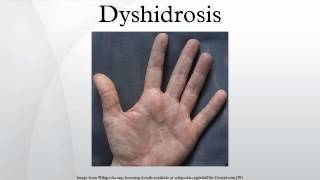 Dyshidrosis [upl. by Goodman]