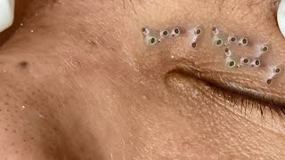 Big Cystic Acne Blackheads Extraction Blackheads amp Milia Whiteheads Removal Pimple Popping 092 [upl. by Neddie]