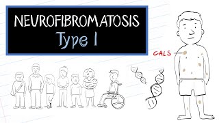 What is Neurofibromatosis Type 1 NF1 [upl. by Tnattirb]