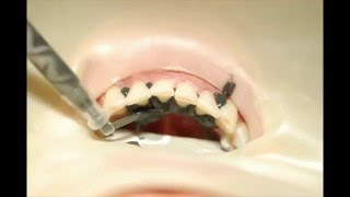 How to fabricate a periodontal splint or fixed orthodontic retainer [upl. by Delfeena]