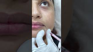 Botox Treatment  Expert Advice and Tips  Cara Clinic [upl. by Pedersen]