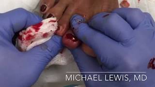 Paronychia  Toe infection Diabetic Infection Pus Toe Nail Removal [upl. by Magnum220]