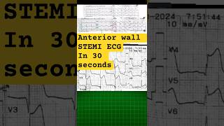 Anterior wall STEMi ecg reading in 30 seconds ecganalysis [upl. by Barnard]