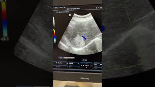 Hepatic Mets  Hemangioma ultrasound sonography hemangioma liver mets hepatic [upl. by Mihcaoj]