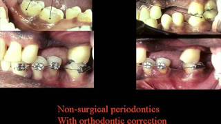 Bayside NY Dentist Periodontist Bone Grafting Dental Implant [upl. by Marlie]