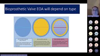 Prosthetic Heart Valve Assessment  Yorkshire regional valve teaching 17012024 [upl. by Onitnas91]