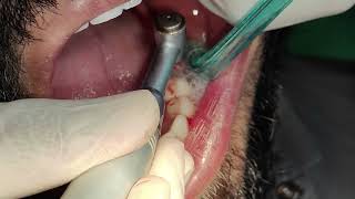 Lower left side first molar implant placement [upl. by Kallick]