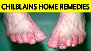 CHILBLAINS QUICK RELIEF  EASY HOME REMEDY FOR CHILBLAINS  CURE FOR SWOLLEN FINGERS DURING WINTER [upl. by Haelem]