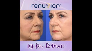 Renuvion Skin Resurfacing [upl. by Aivonas137]