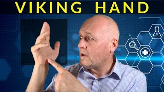 Dupuytren’s Contracture  All about the ‘Viking Hand’ [upl. by Ejrog]