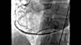 Acute myocardial infarction [upl. by Krenn]