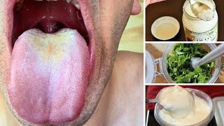 10 Remedios Caseros Para Tratar La Candidiasis Oral [upl. by Astera]