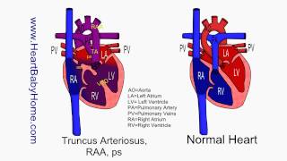 61 Truncus Arteriosus RAA ps [upl. by Ennylcaj946]