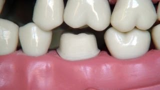 Full metal crown preparation  for dental students [upl. by Llerat]