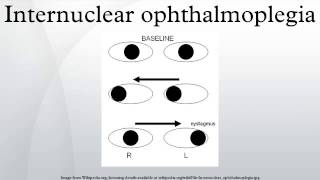 Internuclear ophthalmoplegia [upl. by Castor415]