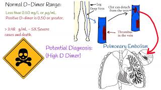 COVID19 and Ddimer Ddimer as a biomarker for disease severity and mortality of Coronavirus [upl. by Nollad879]