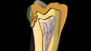 Dental Caries Treatment [upl. by Pessa]