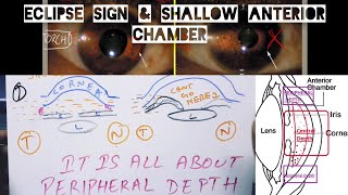 Eclipse sign and Concept of Shallow Anterior Chamber [upl. by Oriole433]