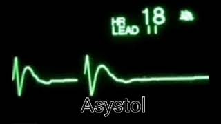 ASYSTOLE AND SVT ON ECG CLIP [upl. by Oine]