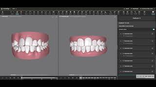 A Treatment Simulation that Avoided Extraction of Four Premolars for Orthodontic Treatment [upl. by Artap]